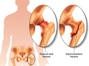 femoral-neck-fracture
